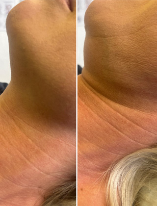 Fat dissolve - Neck before and after