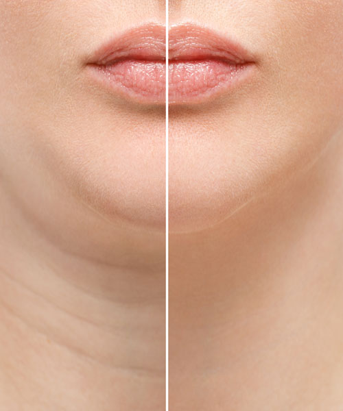 Fat Dissolving Injections