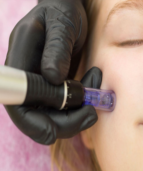 Microneedling